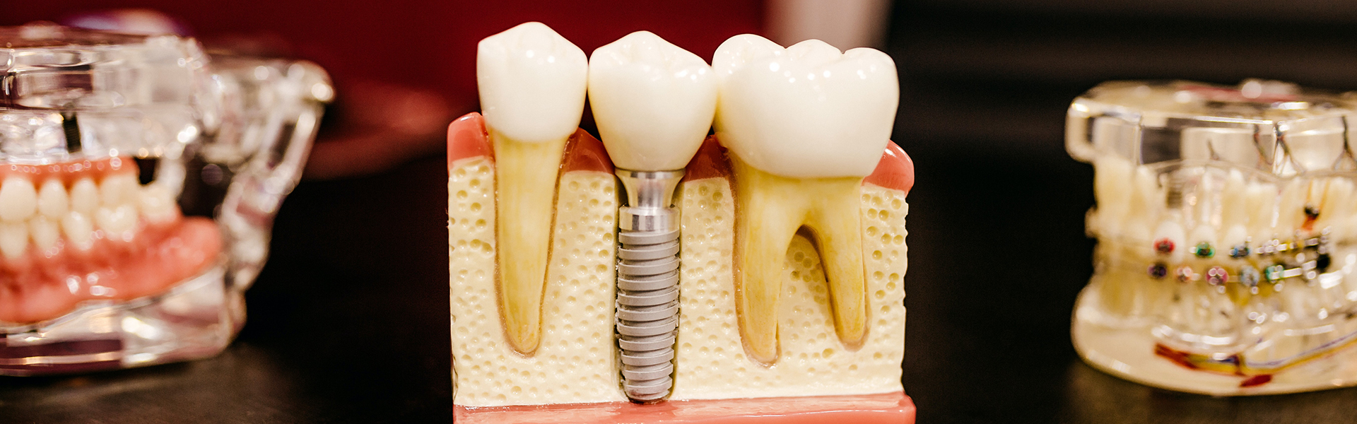 What is guided Implant Surgery?